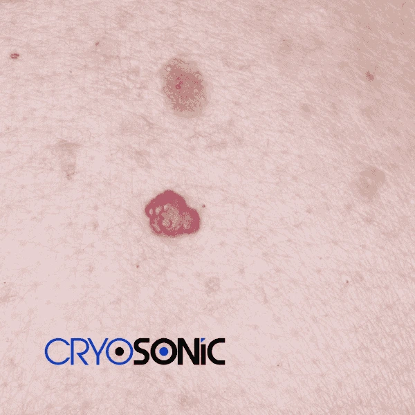 Looking for pain free cherry angioma removal treatment Telford? Call our team today! Telford