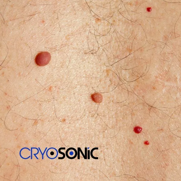 get cherry angioma removal treatment today! Telford