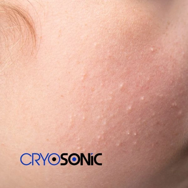 Are you looking for milia removal treatment? Contact our team today Telford