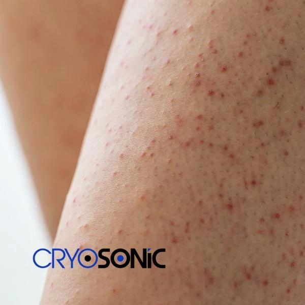 Looking for Seborrhoeic Keratosis removal Telford treatment? Call our consultants today in Telford