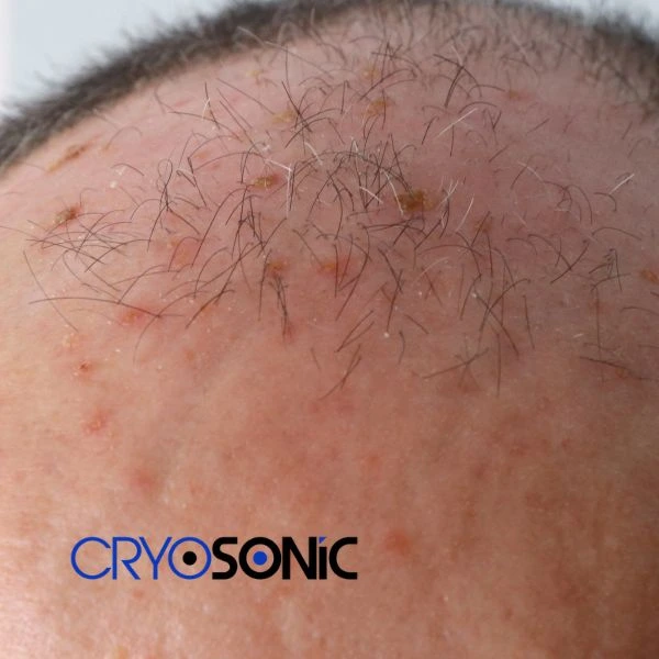 Access Seborrhoeic Keratosis removal from the comfort of your own home! Call us today in Telford