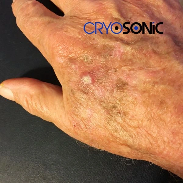 Understand more about actinic keratosis treatment today Telford