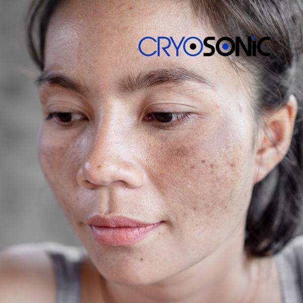 Ready to start age spots removal? Contact our team today in Telford