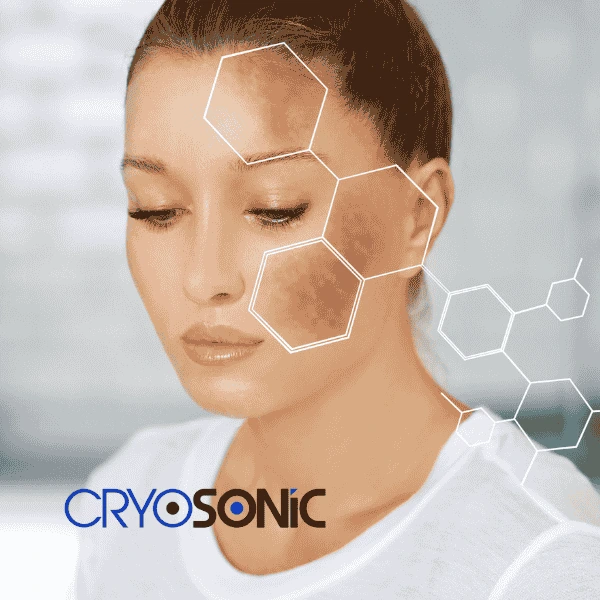 Are you looking for age spot removal treatment? Contact Cryosonic today in Telford