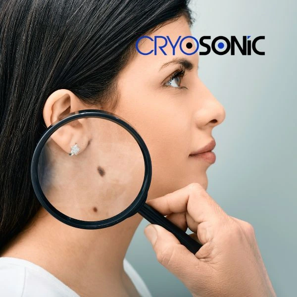 Do you want to learn more about benign moles removal treatment? Call our team today Telford