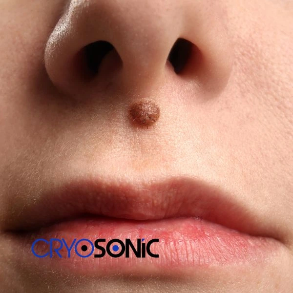Start your benign moles removal treatment today Telford