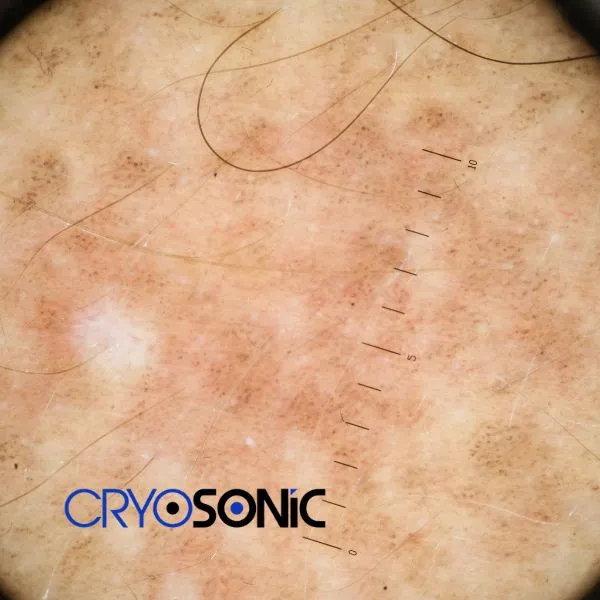 Speak to our team today about sun damaged skin treatment today in Telford