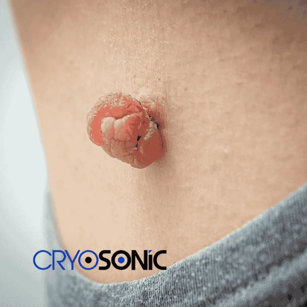 Book your skin tags removal Telford from comfort of your own home! Telford