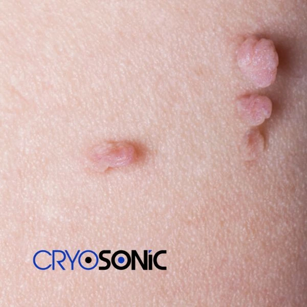 Are you looking for fast effect skin tag removal Telford? Book in NOW! Telford