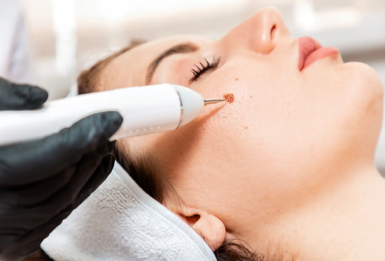 Frequently Asked Questions About Multiple Cryotherapy Treatments Telford
