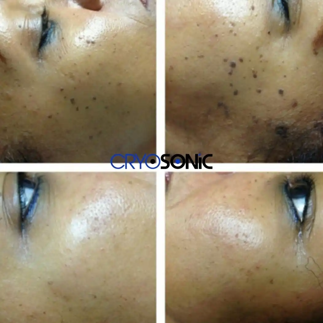 Why Skin Shows Pigmentation After Treatment Telford