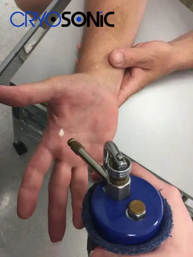 Temperature Differences: OTC vs Medical-Grade Cryotherapy Telford